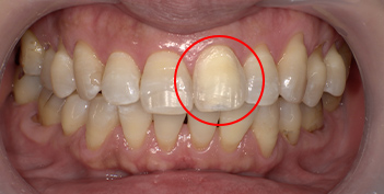 インターナルブリーチの治療例