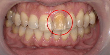 インターナルブリーチの治療例