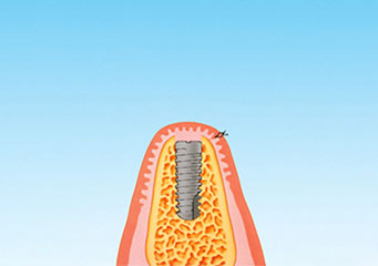 インプラント体を完全に覆うように歯肉を癒着させる。