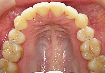 SmileTRU(スマイルトゥルー)の治療例