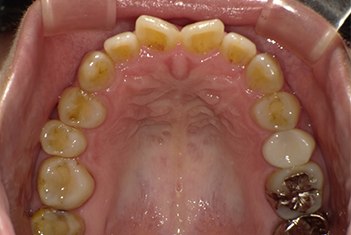 SmileTRU(スマイルトゥルー)の治療例