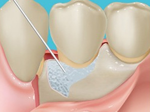 リグロス（歯周組織再生療法）