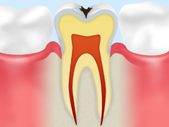 C1エナメル質の侵食