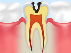 C2象牙質の侵食