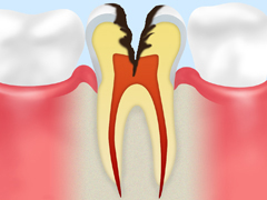 C3歯髄（神経）の侵食