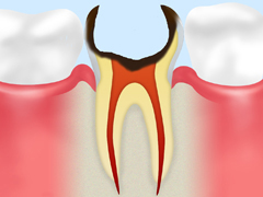 C4歯根への侵食