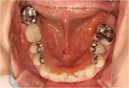 60代女性　インプラント症例