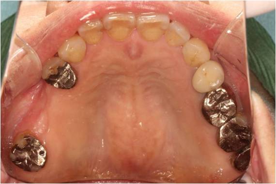 60代女性　インプラント症例