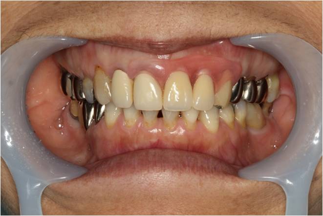 60代女性　入れ歯（ノンクラスプデンチャー）症例