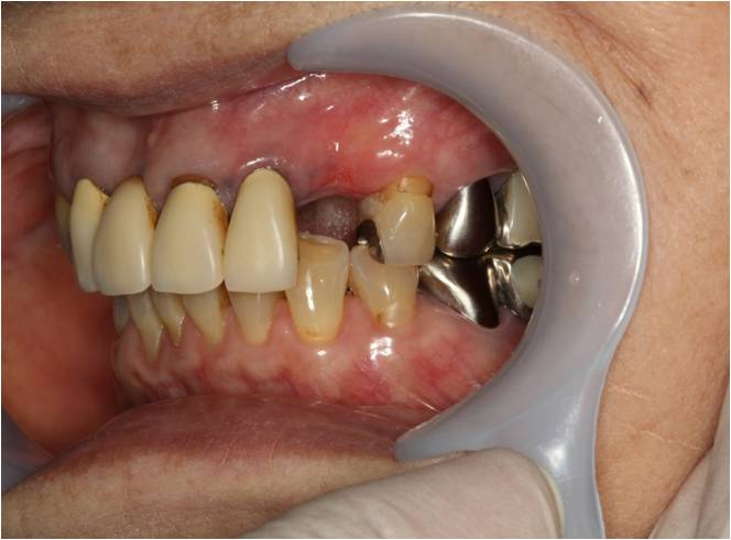 70代女性　入れ歯（ノンクラスプデンチャー）症例