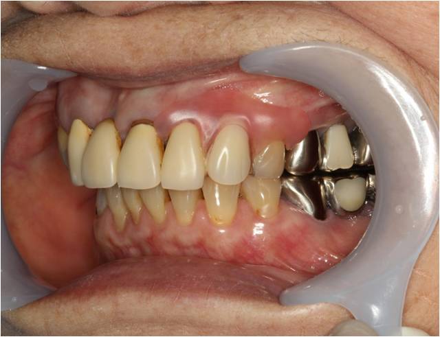 70代女性　入れ歯（ノンクラスプデンチャー）症例