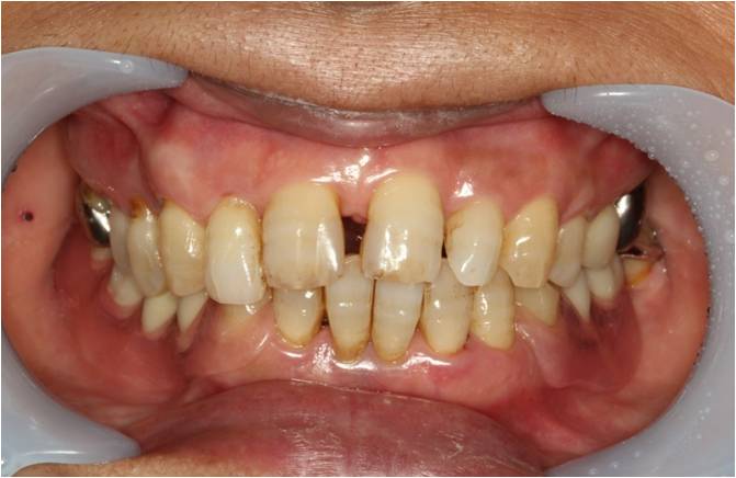 70代女性　入れ歯（スーパーナチュラルデンチャー）症例