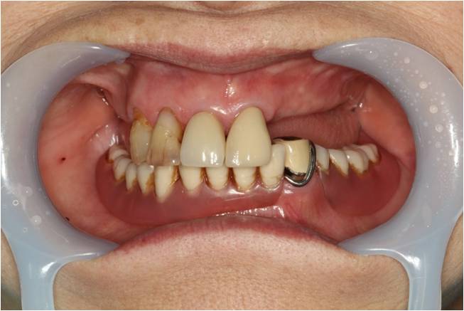 70代女性　入れ歯（スーパーナチュラルデンチャー）症例