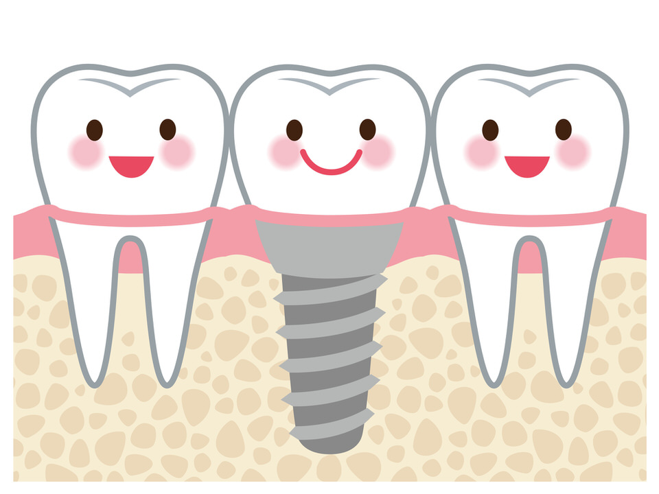 インプラント治療ってどんな治療？