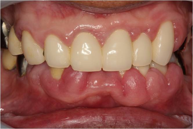 50代男性　薬物性歯肉増殖症症例