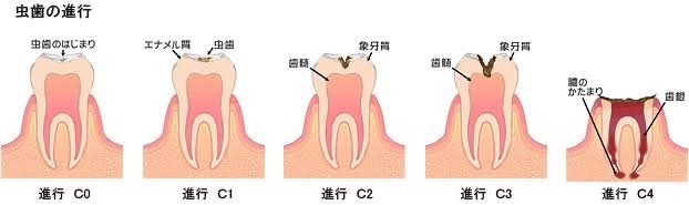 むし歯の進行度を知ろう