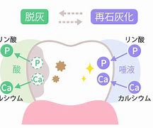 どうしてむし歯になるの？