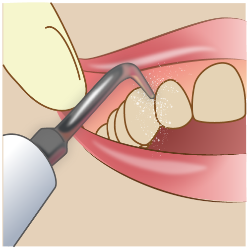 「歯垢」と「歯石」はどう違うの？