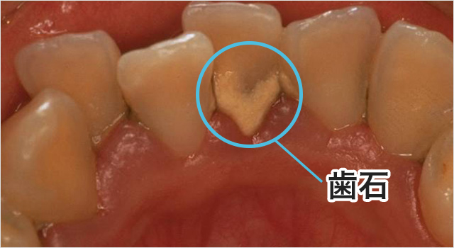 「歯垢」と「歯石」はどう違うの？