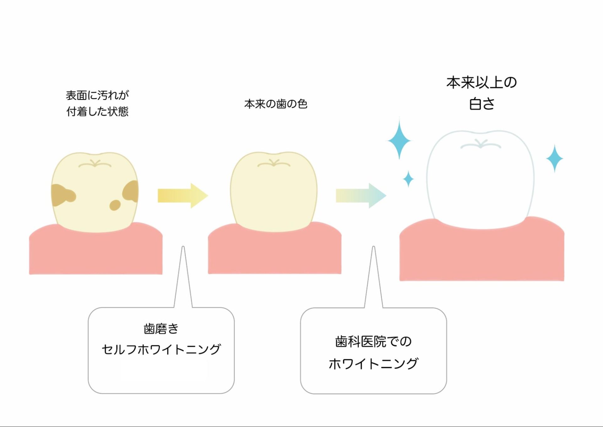 歯って白く出来るの？