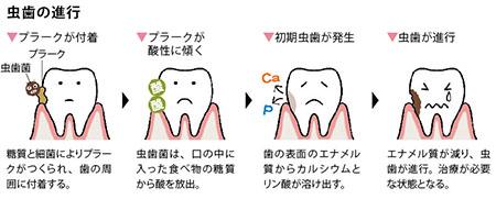 どうしてちゃんと歯磨きしているのに虫歯になるの？