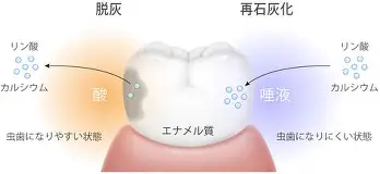 どうしてちゃんと歯磨きしているのに虫歯になるの？