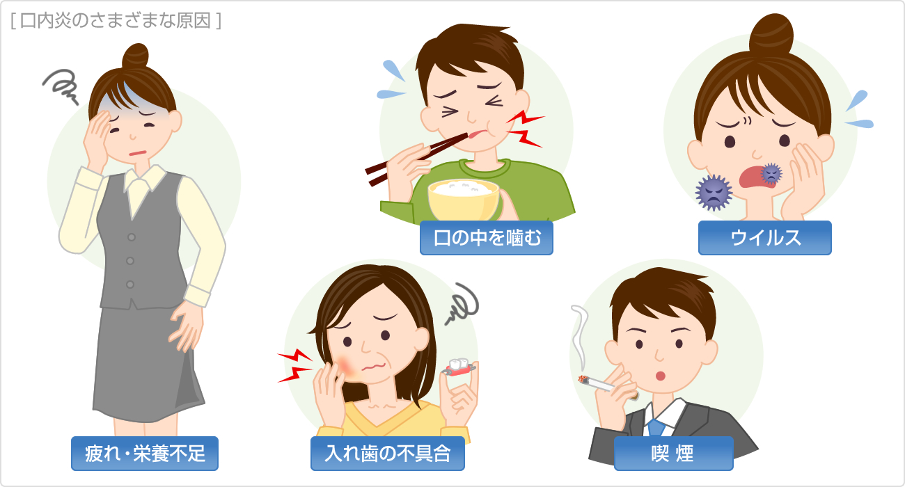 口内炎ってなんでできるの？