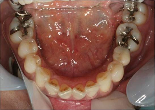 40代女性　左下奥歯　審美的なインプラント治療症例