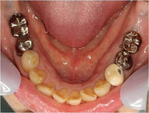 50代女性　インプラント症例